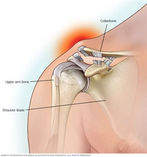 Separated Shoulder Symptoms And Causes Mayo Clinic