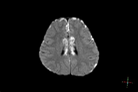 Acute Encephalopathy With Biphasic Seizures And Late Reduced Diffusion