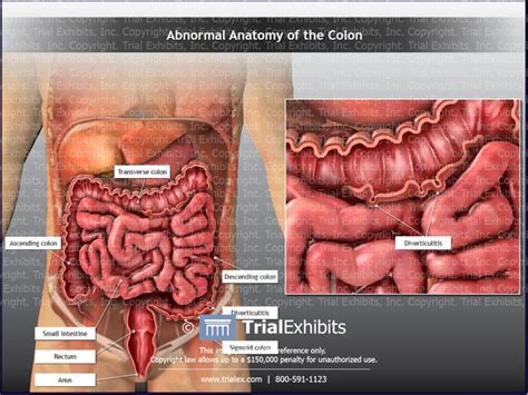 Abnormal Anatomy Of The Colon Trialexhibits Inc