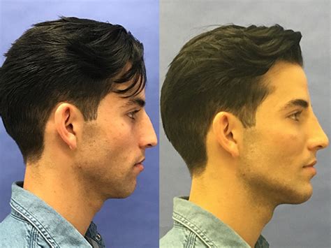 jawline sculpting  minimally invasive   improve  appearance