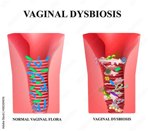 vecteur stock vaginal dysbiosis dysbacteriosis   vagina vaginitis candidiasis