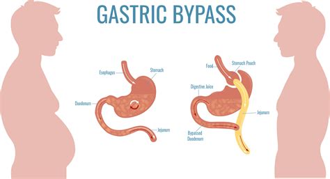 gastric bypass  gastric sleeve compare procedures