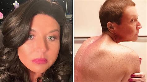 Abby Lee Miller Posts Pictures Of Her Spinal Surgery Scar