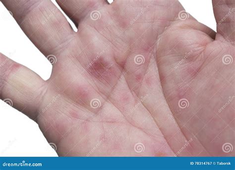 hand foot  mouth disease stock image image  isolated adult