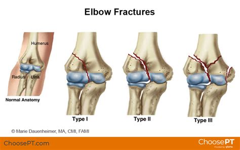 guide physical therapy guide  elbow fracture choose pt