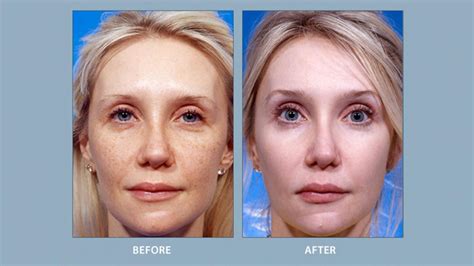 Facial Implants Before And After Facial Cosmetic Surgery