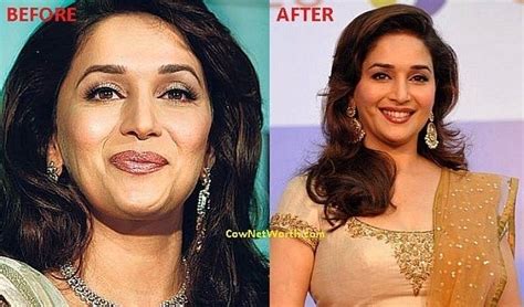 Madhuri Dixit Plastic Surgery Picture Before And After