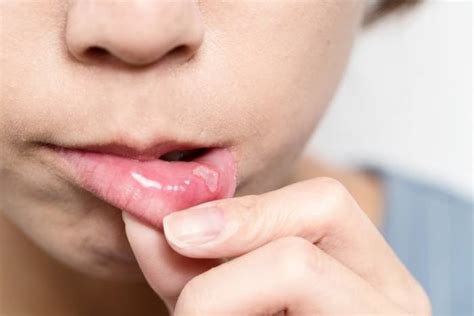Cause Symptoms And Treatment Of Aphthous Stomatitis