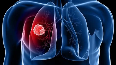 machine learning  detect lung cancer tahsin hassan rahit