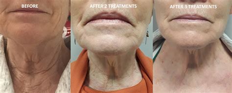 neck tightening    revive laser  skin clinic