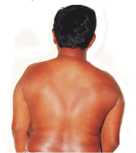 A Patient With Klinefelter Syndrome Showing Narrower