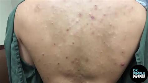 dr pimple popper the biggest blackhead you have ever seen