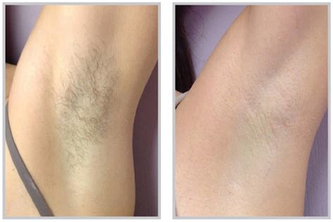 Laser Hair Removal Home