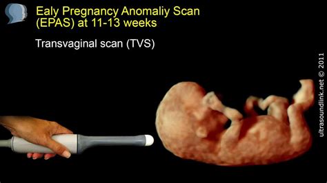 The 12 Week Scan Transabdominal And Transvaginal Ultrasound Youtube
