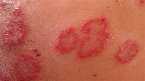 red rash  backsides turn    worms burrowing  skin  holidaying couple