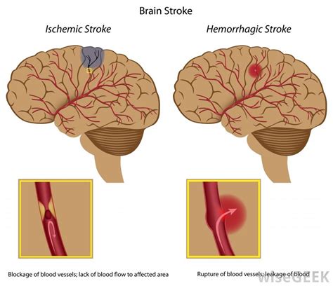 stroke ischaemic  symptoms treatment stroke ischaemic