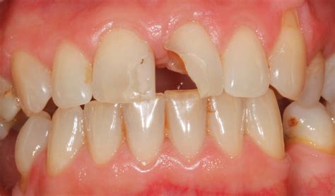 Tooth Coloured Fillings Blackrock Dental Surgery 042 9366979
