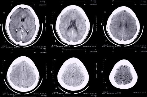 epilepsy monitoring cornwall neurologists