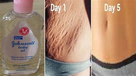 Worlds Best Remedy For Fast Stretch Mark Removal In 5 Days Remove