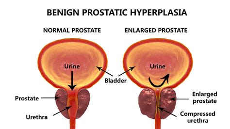 diagnosing an enlarged prostate bph
