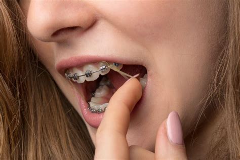 Why Orthodontic Rubber Bands Matter Wiewiora And Dunn Orthodontics