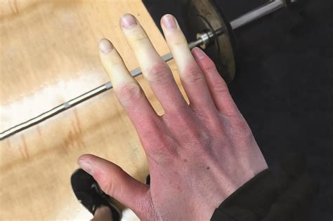 Drug Induced Raynaud’s Phenomenon ‘probably Underestimated’ The