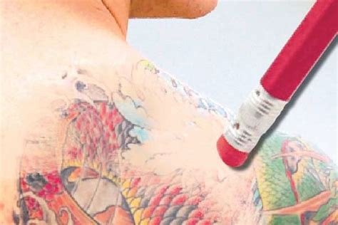 points    mind  choosing  tattoo removal service