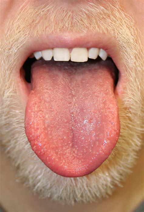 sore white bumps  tongue