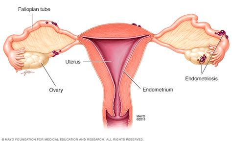 endometriosis síntomas y causas mayo clinic