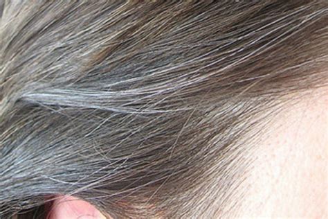 premature greying white hair treatment in delhi india