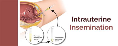 intrauterine insemination iui uses risks and success rate