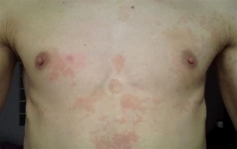 hiv rash what does it look like and how is it treated