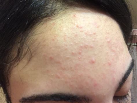 small slightly red bumps   forehead general acne