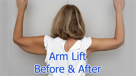 arm lift  weeks post op faqs brachioplasty surgery journey part  youtube