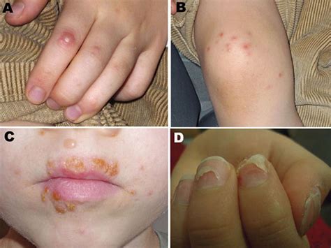 hand foot and mouth disease what to know about virus that disabled