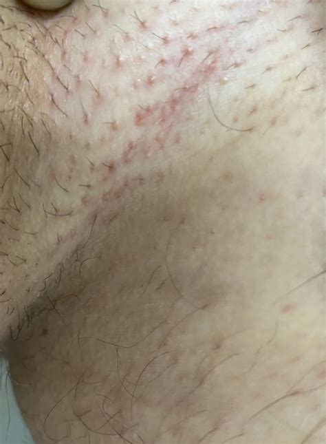 Herpes Or A Rash Itches And Hurts Sometimes 2weeks Old Genital