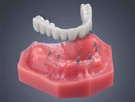 long  mini dental implants  dental news network