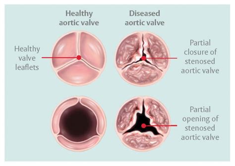 Aortic Stenosis Anatomy Diagnosis Treatment The Valve Clinic