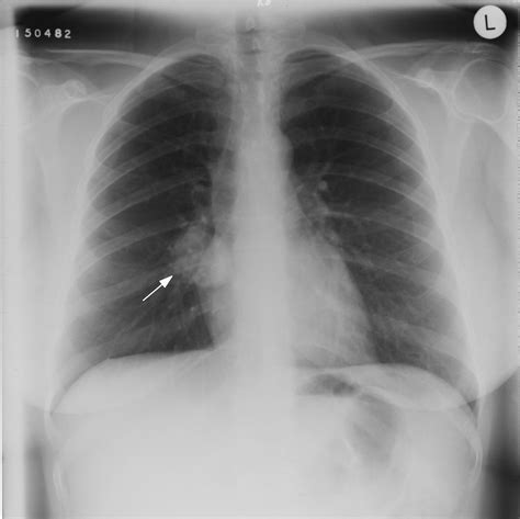 pulmonary nodules treatment