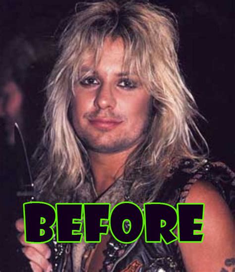 vince neil plastic surgery before and after brow lift