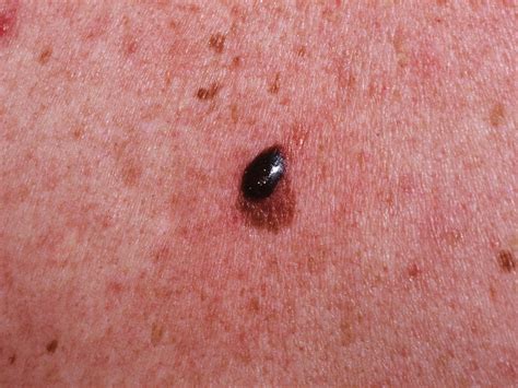 skin cancer types symptoms melanoma treatment