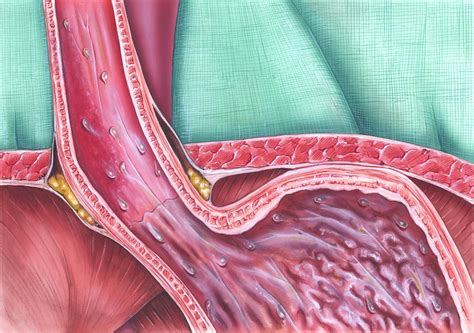 overview  gastrointestinal dysfunction  systemic sclerosis rheumatology advisor