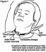 Tracheostomy Trach Care Instructions Patients Teaching Therapy Nursing Respiratory Slp Medical System Clevelandclinic Nurses sketch template