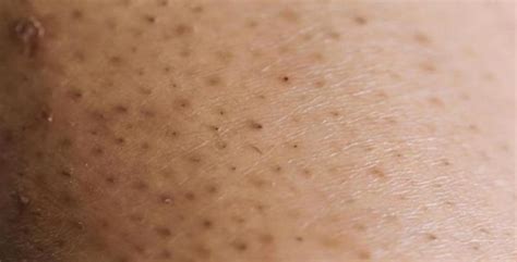 what causes ingrown leg hairs and how to prevent them