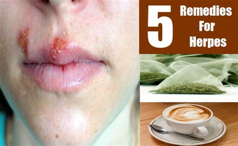 5 remedies for herpes natural treatments and cure for herpes search herbal and home remedy