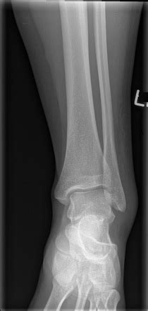 ankle ap view radiology reference article radiopaediaorg