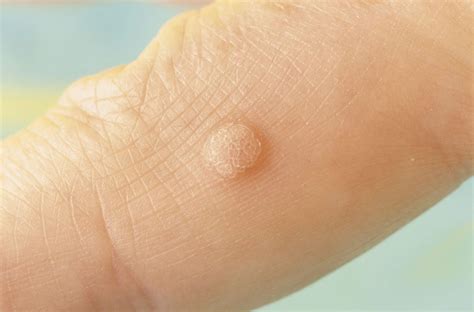 skin conditions symptoms treatments diagnosis healthcom