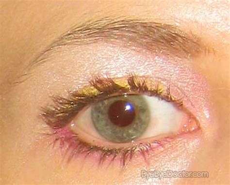 pink eye pictures symptoms treatment contagious remedies
