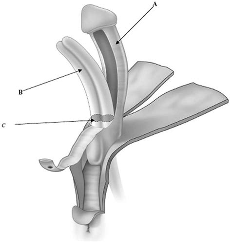 frontiers treatment of the enlarged clitoris