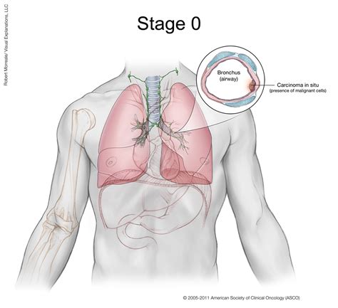 Lung Cancer Stage 0 Cancer Net